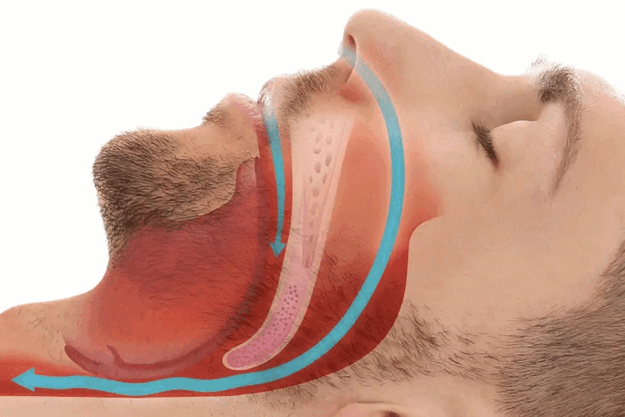 PROTETOR BUCAL ANTI-RONCO - PROSLEEP™