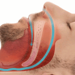 PROTETOR BUCAL ANTI-RONCO - PROSLEEP™