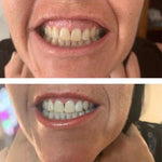 BRANQUEADOR DE DENTES COM CARVÃO ACTIVADO E EXTRACTO DE PLANTAS - WHITETH™